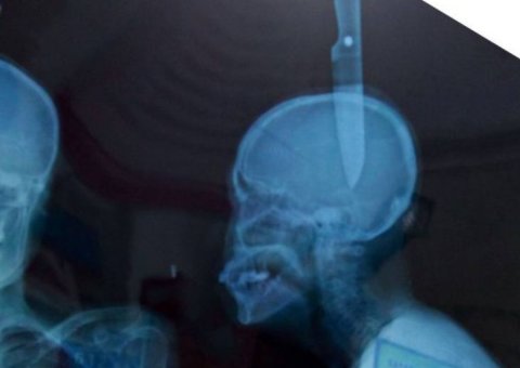 Mulher cai da escada e faca entra em seu crânio