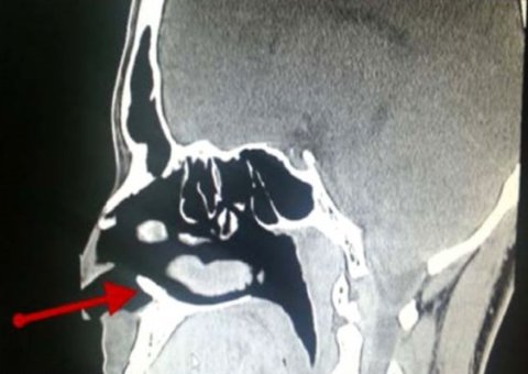 Homem descobre que hemorragia era motivada por dente que nasceu no nariz
