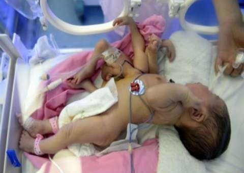  Bebê com gêmeo parasita, nasceu com 4 braços e 4 pernas