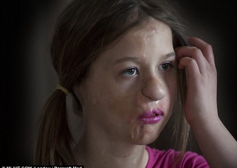 Menina de 12 anos que perdeu a orelha em ataque de guaxinim tem novo órgão crescido em seu braço