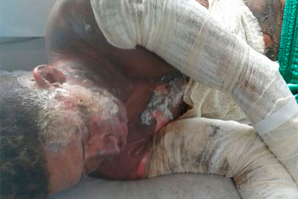 Jovem ateia fogo no próprio corpo