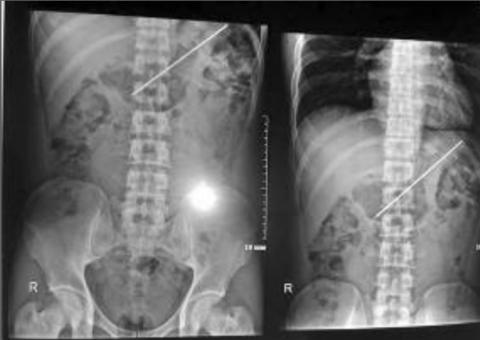 Médicos retiram do estômago de chinês espeto preso por um mês