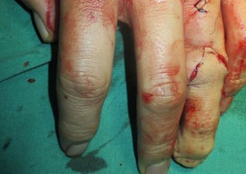 Médicos reimplantam dedo do pé na mão de paciente