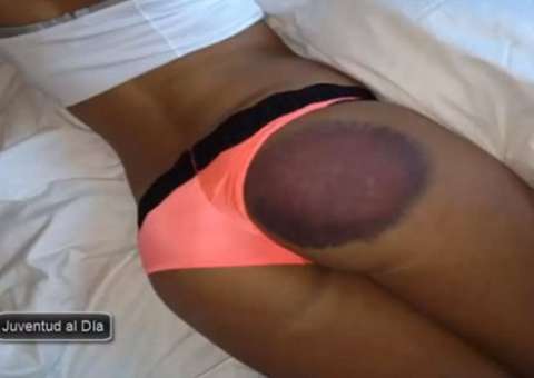 Modelo processa "Playboy" por hematoma gigante ao ser usada como bola de golf