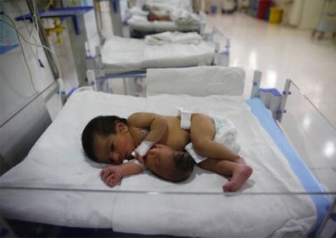 Bebê nasce com uma cabeça no estômago