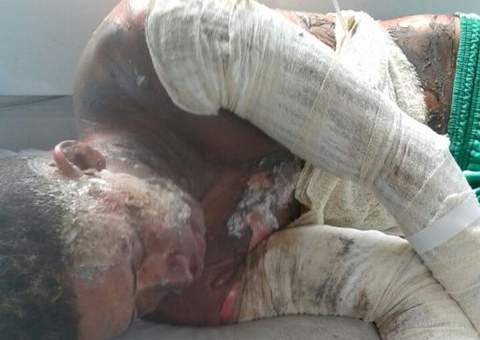 Jovem ateia fogo no próprio corpo