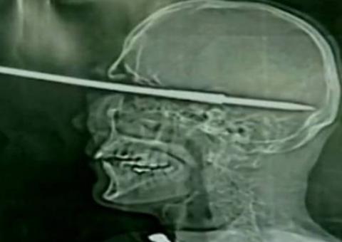 Bruno dispara arpão de pesca contra a própria cabeça  