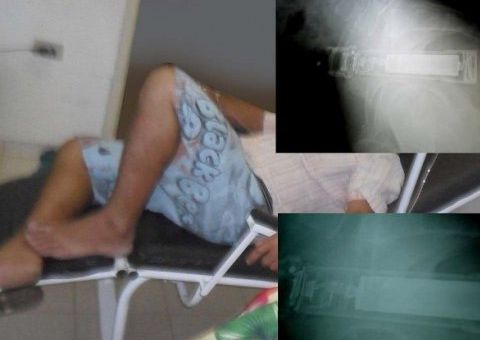 Vindo do Acre, caminhoneiro descobre que tinha uma lanterna enfiada dentro de si