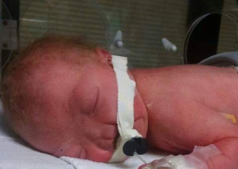   Mãe acusa Facebook de censurar fotos do filho que nasceu sem nariz