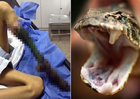 Menina fica com perna apodrecida após levar picada de cobra venenosa e tratar com remédios naturais