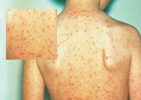 SUS oferta vacina contra catapora a partir deste mês