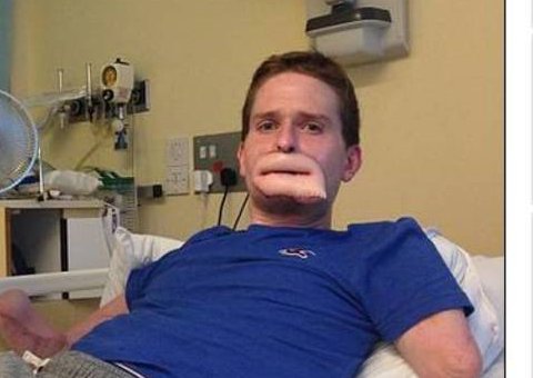 Jovem tem lábios reconstruídos após ter parte do rosto devorado por bactéria