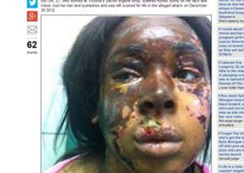 Universitária jogou ácido no rosto da amiga por inveja