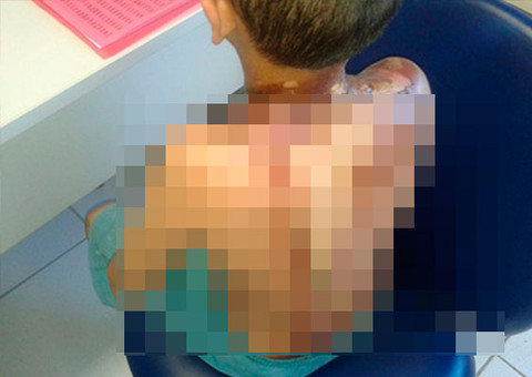 Mulher queima enteado que deixou a casa desarrumada