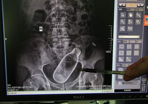 Homem estimulou o ânus com garrafa para ajudar na prisão de ventre 