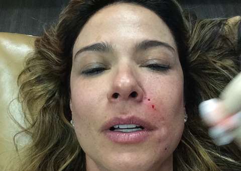 Luciana Gimenez mostra rosto sangrando durante tratamento estético