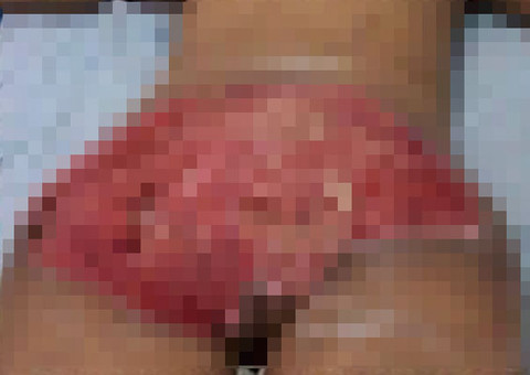 Após suposta traição, homem arranca bunda da esposa com facão