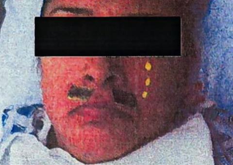 Médico é processado por desenhar bigode em paciente e postar no Facebook