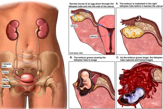Mulher engravida e após 38 anos tem seu bebê retirado do ventre