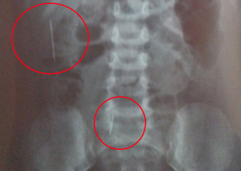 Padrasto torturava bebê de 3 anos enfiando agulhas no corpo 