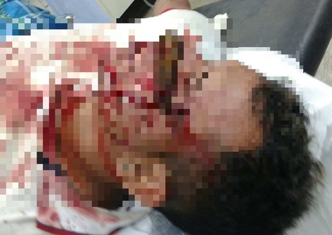 Homem leva facada no rosto e sobrevive