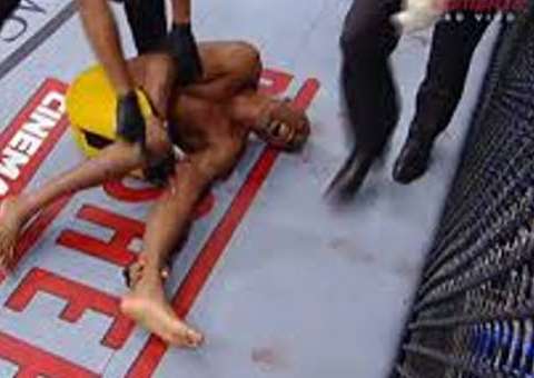 Anderson Silva  poderia ter a perna amputada, diz médico