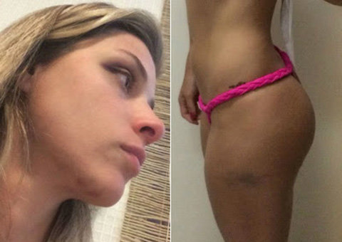 Angela Sousa desabafa na web e mostra hematomas pelo corpo