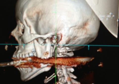 Mulher é atingida por arpão disparado acidentalmente