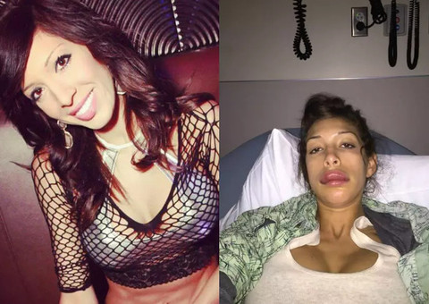 Após cirurgia nos lábios, atriz pornô fica irreconhecível e vira piada na web