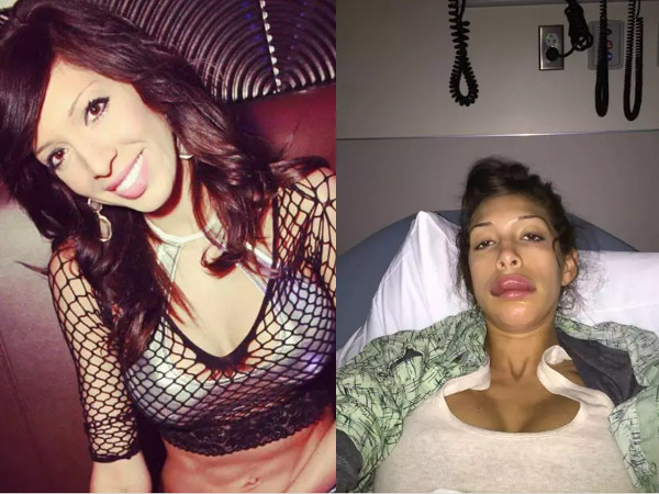 Após cirurgia nos lábios, atriz pornô fica irreconhecível e vira piada na web