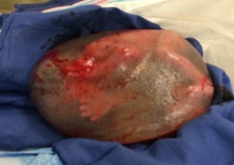  Bebê nasce dentro da bolsa amniótica