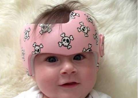 Acessórios são usados para corrigir assimetrias cranianas das crianças