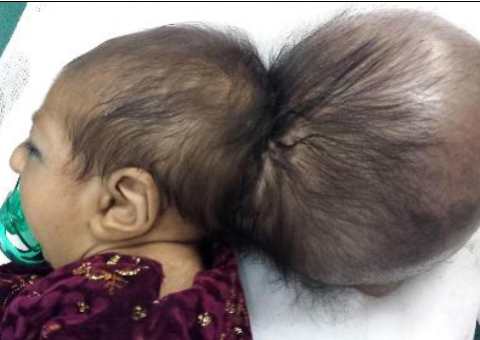Médicos afegãos retiram 'segunda cabeça' do crânio de um bebê