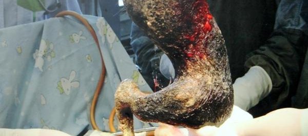 Médicos removem bola de pelo de 4 kg de estômago de adolescente