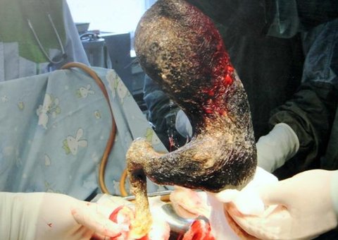 Médicos removem bola de pelo de 4 kg de estômago de adolescente