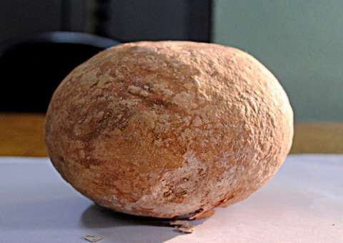 Pedra de quase 1kg é retirado da bexiga de um homem