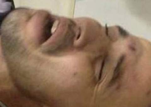 Após perder a perna e o braço durante assalto, ladrão é abandonado pelos comparsas: "foi mau"