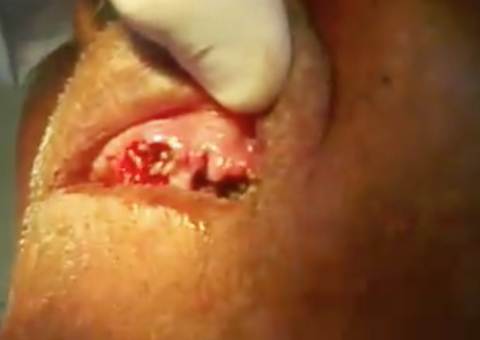 Veja o que acontece quando a higiene bucal não está em dia