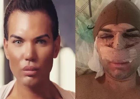 Rodrigo Alves, comparado a um boneco, faz mais seis plásticas 
