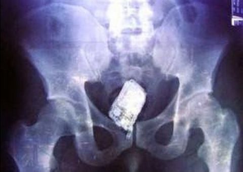 Pistola e celular são encontrados dentro do ânus de detento