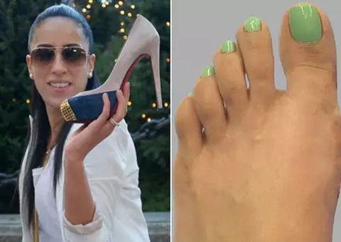 Mulher faz a 'Cirurgia da Cinderela' para usar salto alto