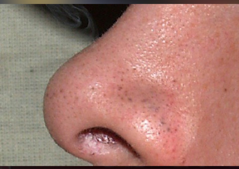 Confira uma forma fácil de retirar aqueles pontos escuros do seu nariz