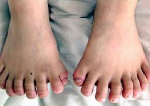 Mutação Genética faz menino de seis anos ter 31 dedos