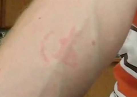 Estudante cria tatuagem temporária feita com percevejos
