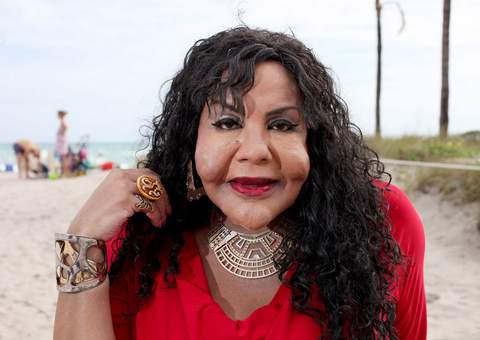 Vítima que teve cimento colocado em seu rosto após procedimento estético exibe novo visual