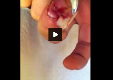 Jovem filma enquanto arranca a própria unha