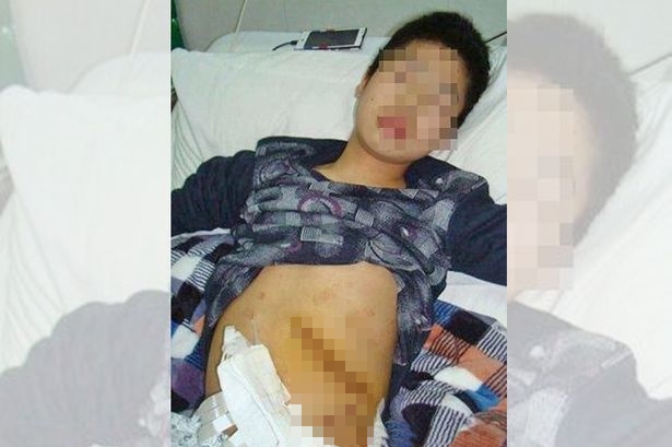 Estudante tem baço removido após ser atacado por professor depois de roubar lanche de colega