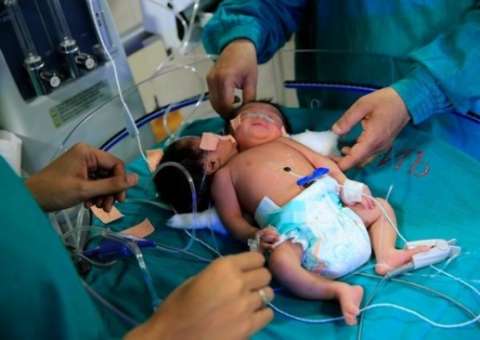 Siameses raros foram transferidos para um hospital na Índia 