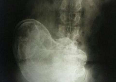 Mulher carrega feto há 44 anos no abdômem