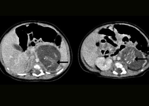 Bebê com condição rara nasceu grávido de gêmeos na china
